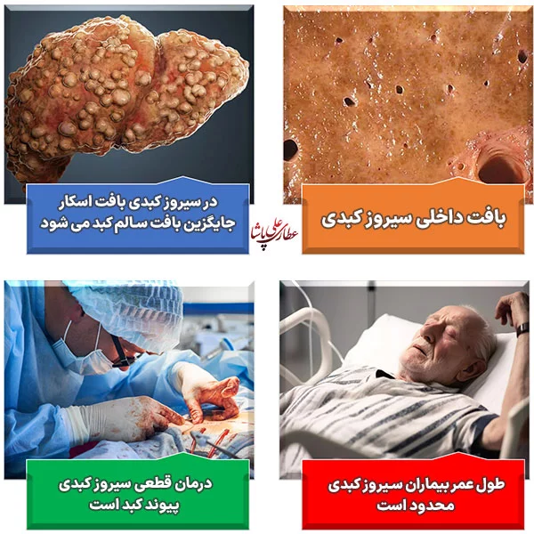 درمان قطعی سیروز کبدی فقط با پیوند کبد امکان دارد و عمر بیماران سیروز کبدی 2تا 12سال است