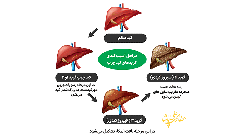 گریدهای کبدی و مراحل آسیب کبدی